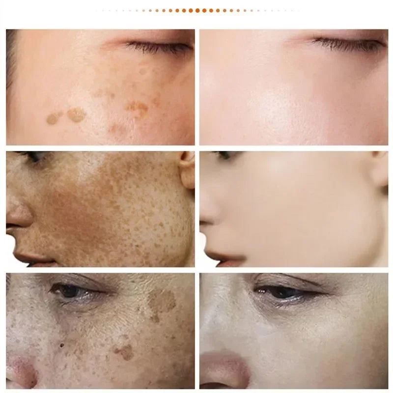 Niacinamide Melasma Brightening Cream Reduce Melanin Brighten Cream Lighten Dark Skin Chloasma Serum Fade Fine Lines Face Care